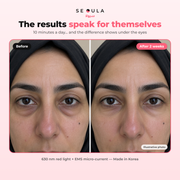 SEOULA Eyes™ Korean Under-Eye Device