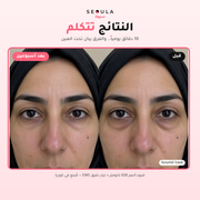 سيولا آيز™ الجهاز الكوري لمحيط العين
