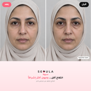 سيولا آيز™ الجهاز الكوري لمحيط العين