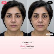سيولا آيز™ الجهاز الكوري لمحيط العين