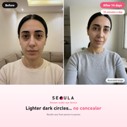 SEOULA Eyes™ Korean Under-Eye Device