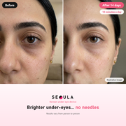 SEOULA Eyes™ Korean Under-Eye Device