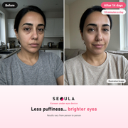 SEOULA Eyes™ Korean Under-Eye Device