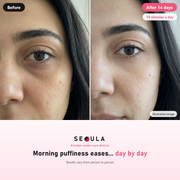 SEOULA Eyes™ Korean Under-Eye Device